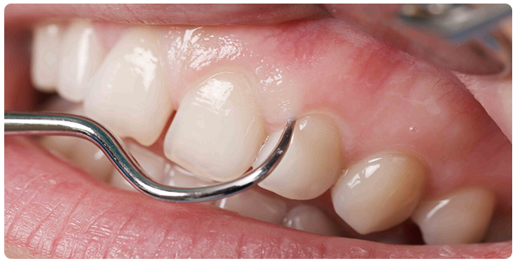 periodontal tedavileri