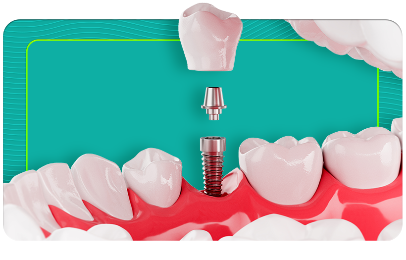 Diş ekimi ile profesyonel uygulamalarla kalıcı ve kesintisiz konfor öneriyoruz